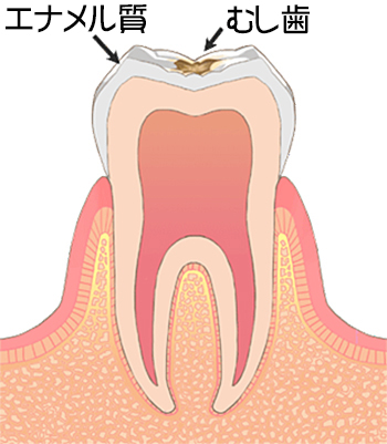 C1：エナメル質のう蝕